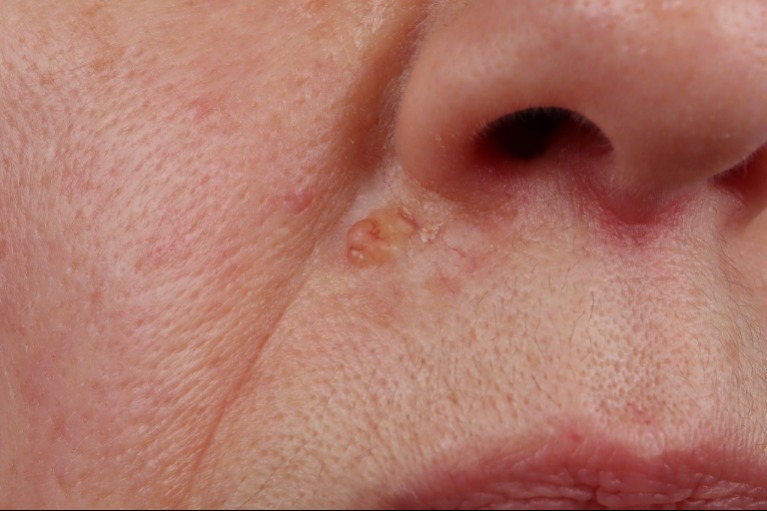 9 tünet, ami arra utal, hogy rákos daganat növekszik a szervezetedben