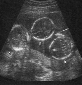 A 42 éves nő hármasikrekkel volt várandós: aztán az orvos megdöbbentő dolgot mondott