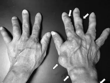 Ezek az ízületi porckopás tünetei és okai