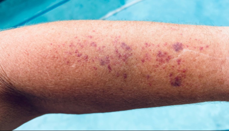 Innen lehet tudni egy rákos betegnél, hogy nagy a baj