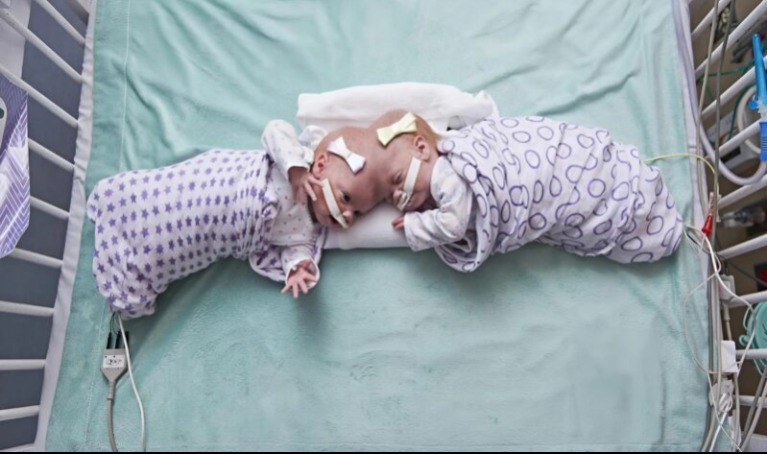 Szétválasztották őket – most így élnek: megrázó, ami a sziámi ikerlányokkal történt