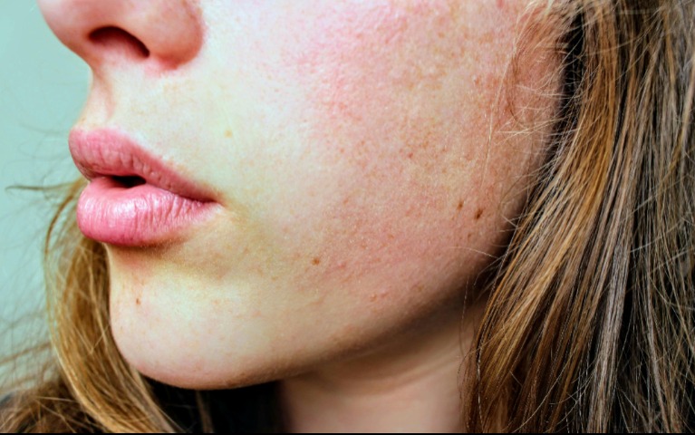 A-vitamin-hiány a háttérben: a szemünk, a bőrünk és az immunrendszerünk is jelez